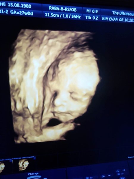 peanut is on the way, first grandchild, 3d scan of baby in the womb, granny in waiting